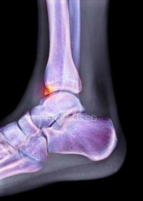 Radiographie colorée du pied d'un patient masculin de 22 ans avec éperon (ostéophyte, mis en évidence) affectant le tibia (os du tibia) ). — Photo de stock