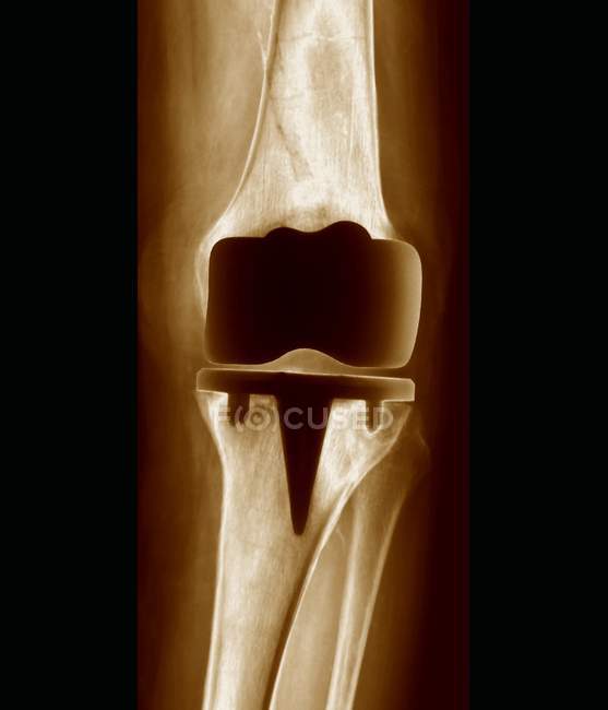 Протезування колінного суглоба — стокове фото