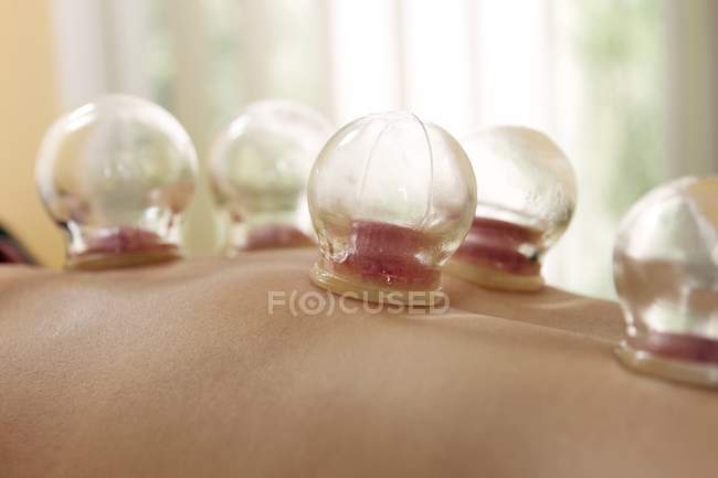 Primo piano di tazze riscaldate sulla schiena del cliente per la terapia di coppettazione . — Foto stock