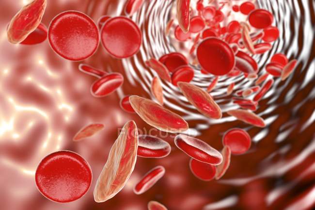 Sickle cell anemia — Stock Photo