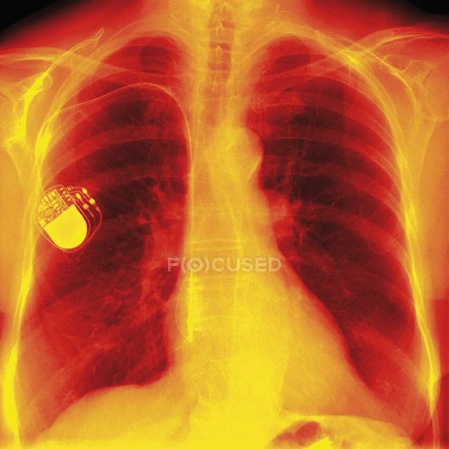 Chest with a heart pacemaker — Stock Photo