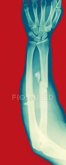 Fractured arm, coloured X-ray. — Stock Photo
