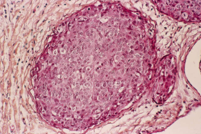 Breast tissue showing adenocarcinoma — Stock Photo