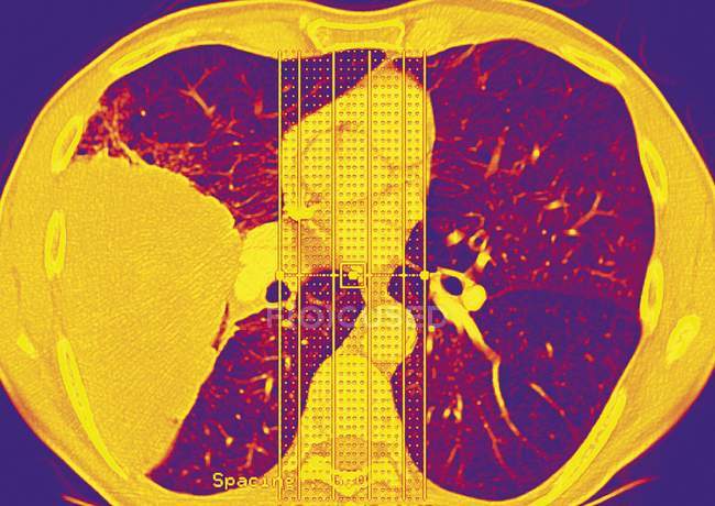 Осьове комп'ютерне томографічне сканування грудей, що показують ракову пухлину в легенях . — стокове фото
