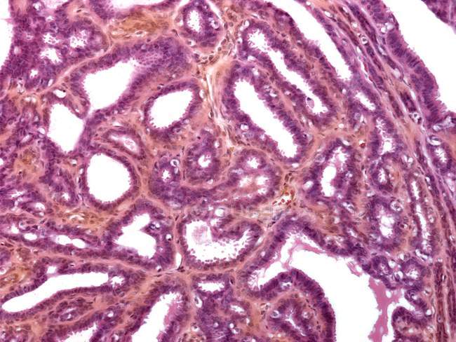 Micrografía ligera de una sección a través del tejido mamario que muestra mastitis (inflamación) de la mama
. - foto de stock