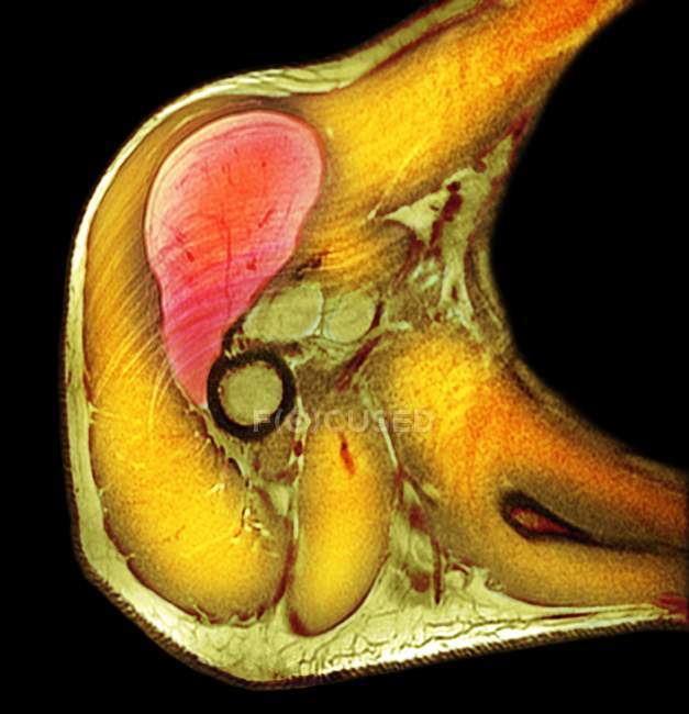 X-ray of large shoulder lipoma — Stock Photo