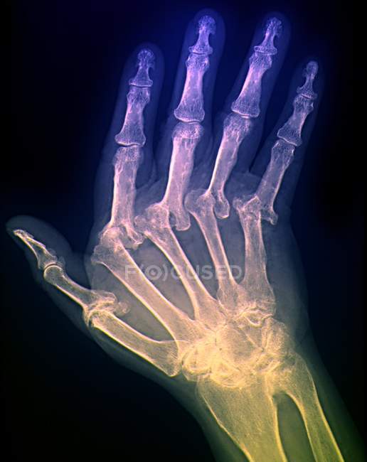 Arthritic hand anatomy — Stock Photo
