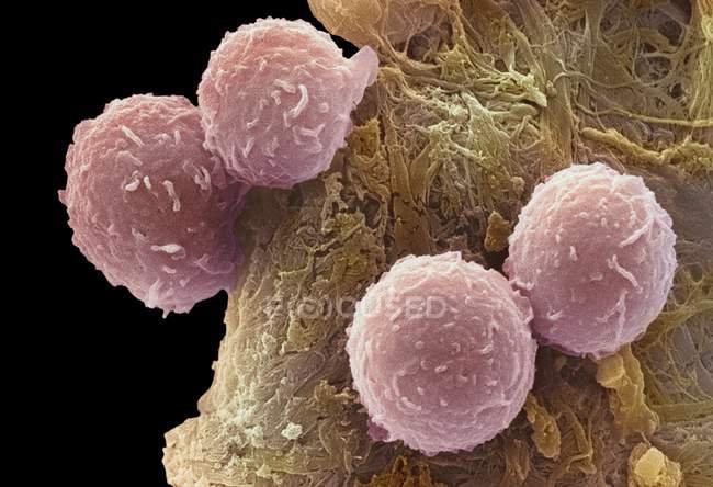Leucemia células sanguíneas - foto de stock