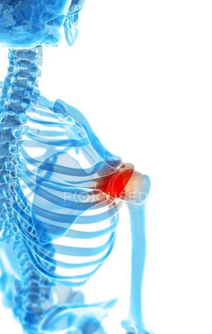 Area of inflammation in shoulder joint — Stock Photo