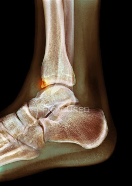 Цветной рентген стопы 22-летнего пациента-мужчины со шпором (остеофит, выделенный), поражающим большеберцовую кость (голень) ). — стоковое фото