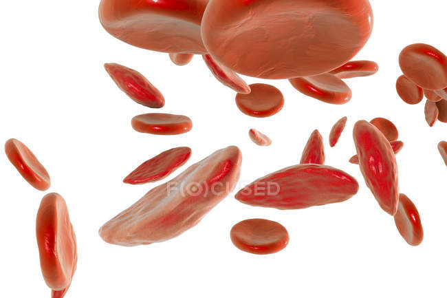 Anemia falciforme — Foto stock