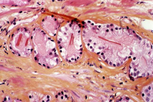 Tecido da próstata mostrando Iadenocarcinoma — Fotografia de Stock