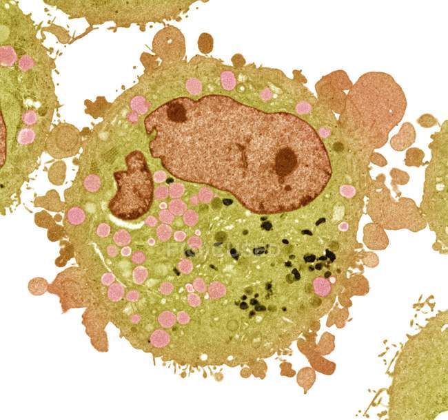 Célula de carcinoma, micrografia electrónica de transmissão colorida (MET
). — Fotografia de Stock