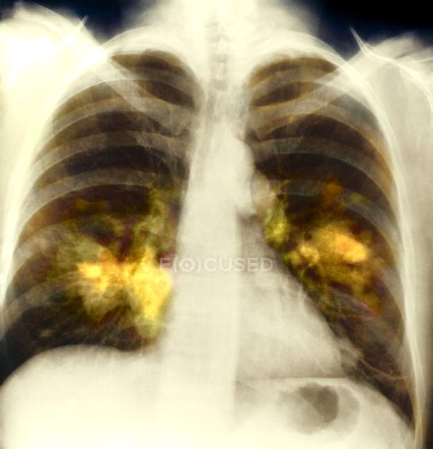 Radiografía de color que muestra cáncer en el pulmón izquierdo de un paciente de 55 años
. - foto de stock