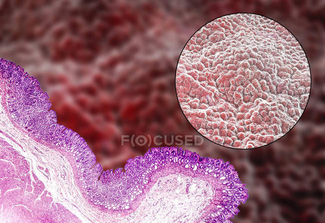 Micrografía ligera (abajo a la izquierda) e ilustración por computadora (arriba a la derecha) del revestimiento del estómago, conocida como la mucosa . - foto de stock