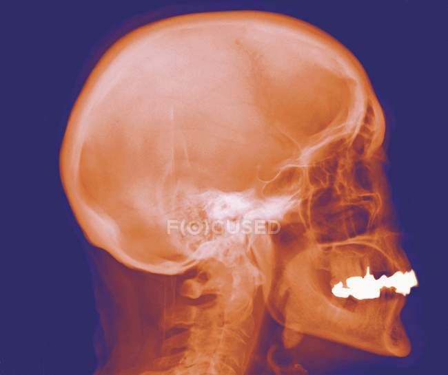 Struttura normale del cranio di un giovane adulto — Foto stock