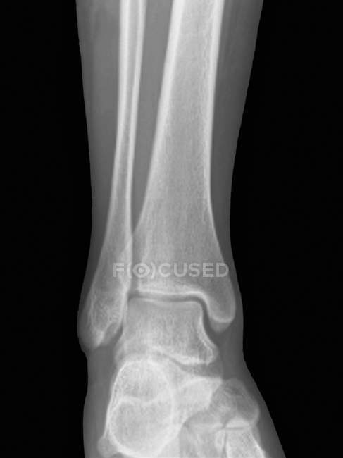 Normal ankle joint, frontal X-ray. — Stock Photo