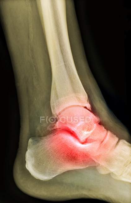 Ankle of patient with osteoarthritis — Stock Photo