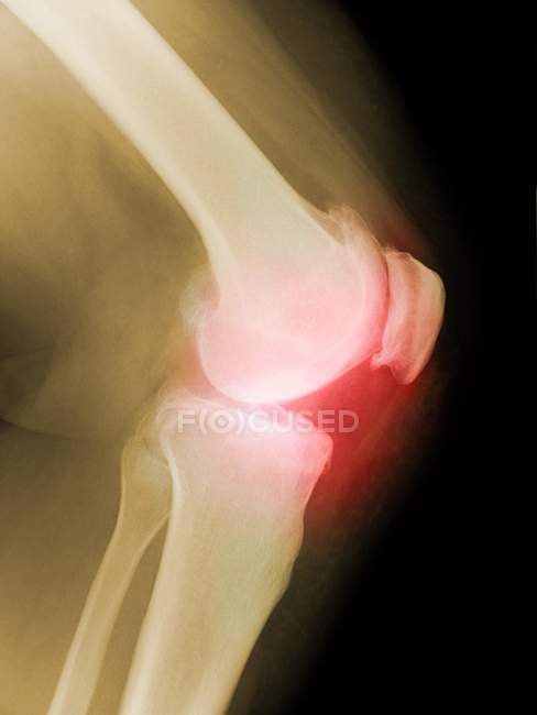 Цветной рентген артритных коленей — стоковое фото