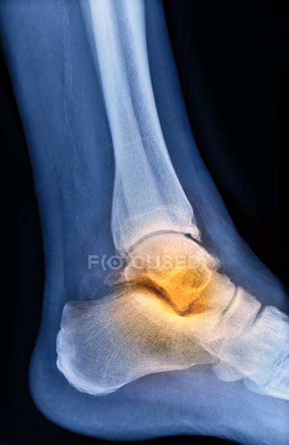 Caviglia del paziente con osteoartrite — Foto stock