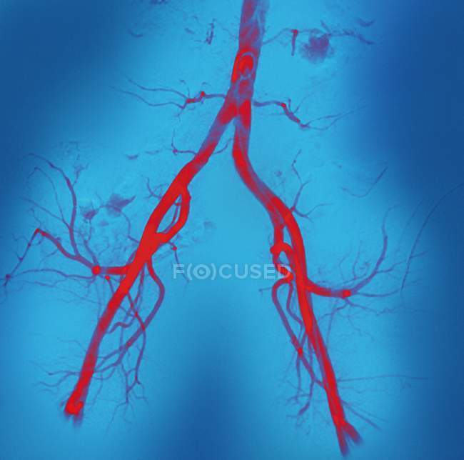 Angiografía coloreada (radiografía de los vasos sanguíneos) de las arterias de la región pélvica . - foto de stock