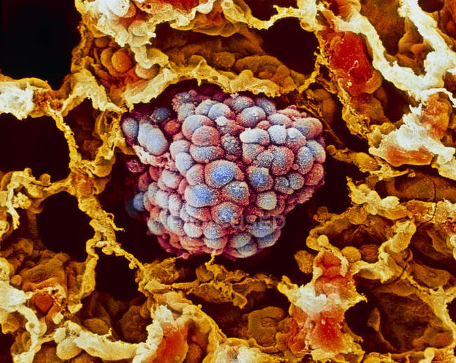 Tumore che riempie un alveolo del polmone umano — Foto stock