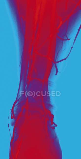Normal leg veins, coloured angiogram - blood vessel X-ray — Stock Photo
