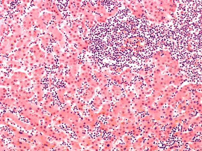 Micrographie photonique des cellules sanguines (principalement des cellules B, violet foncé) dans le foie d'un patient atteint de leucémie lymphocytaire . — Photo de stock