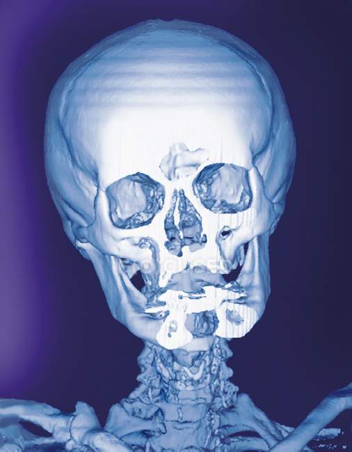 Anatomía normal del cráneo de adultos jóvenes - foto de stock