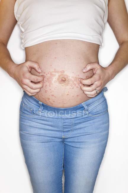 Pregnant woman scratching rash on tummy — Stock Photo