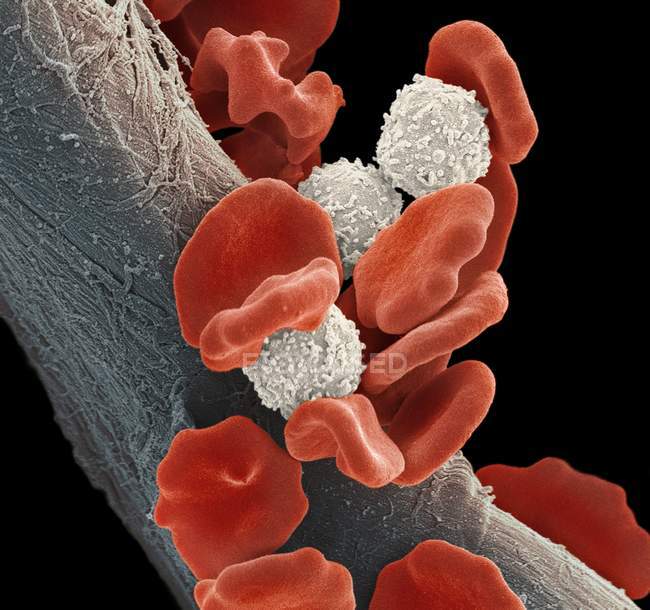 Leucemia células sanguíneas - foto de stock