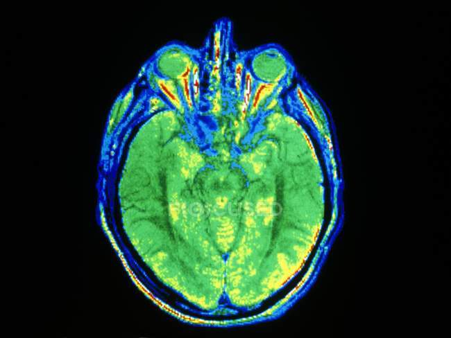 ХИБНІСТЬ колір магнітні зображення резонанс (МРТ) осьовий розділу через людської голови, показ поділ основна частина мозку на ліва і права півкуля. — стокове фото