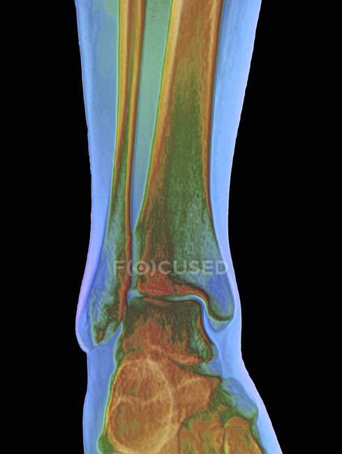 Normal ankle joint, coloured frontal X-ray. — Stock Photo