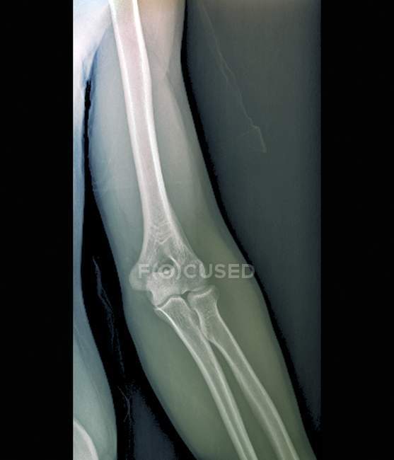 Anatomia normale delle articolazioni del gomito — Foto stock