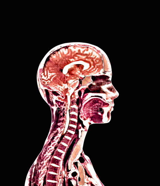 Cerebro y médula espinal - foto de stock