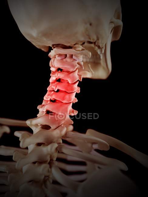 Dolor de cuello que afecta las vértebras cervicales - foto de stock