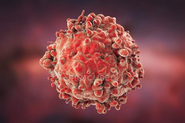 Glóbulos blancos cancerosos en la leucemia - foto de stock
