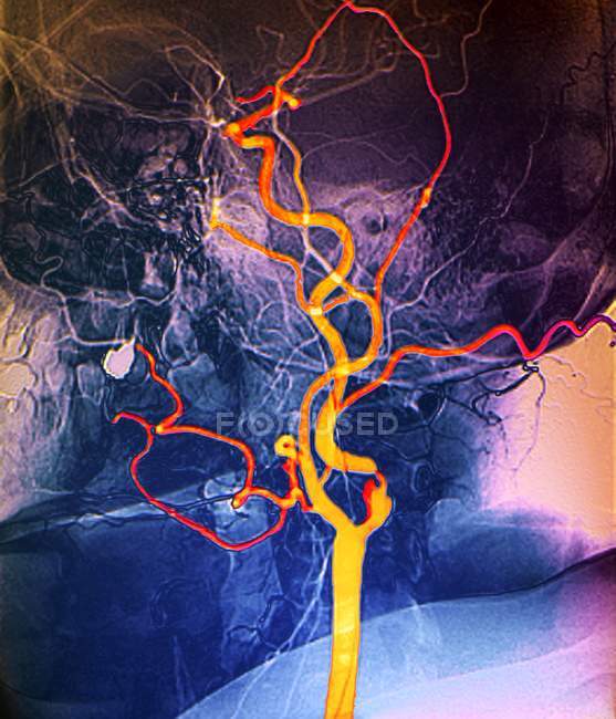 Angiografía coloreada de la arteria carótida en el cuello del paciente maduro
. - foto de stock