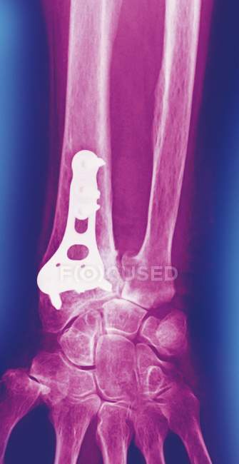 Pinned wrist fracture, coloured frontal X-ray. — Stock Photo