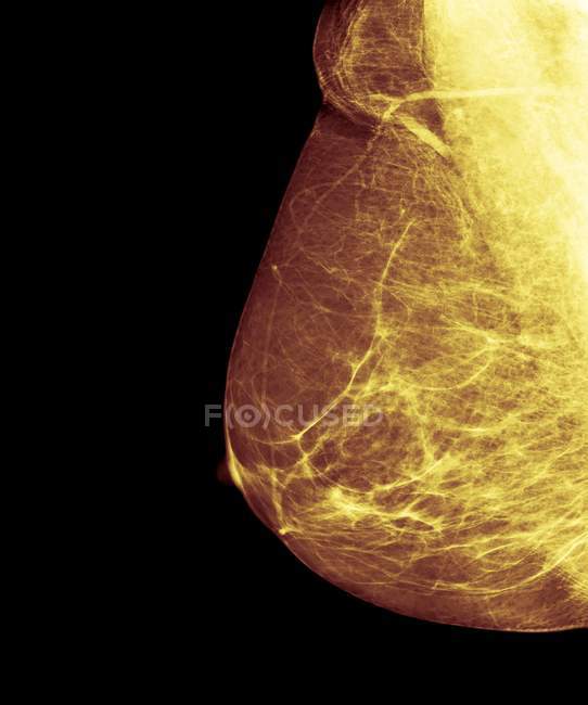 Detección del cáncer de mama - foto de stock