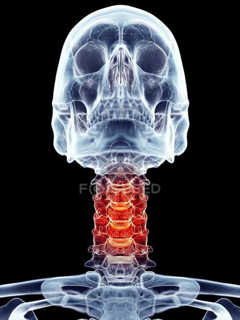 Dolor en el cuello localizado en vértebras cervicales - foto de stock