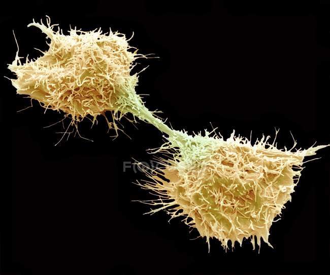 Células del fibrosarcoma en fase tardía de la mitosis - foto de stock