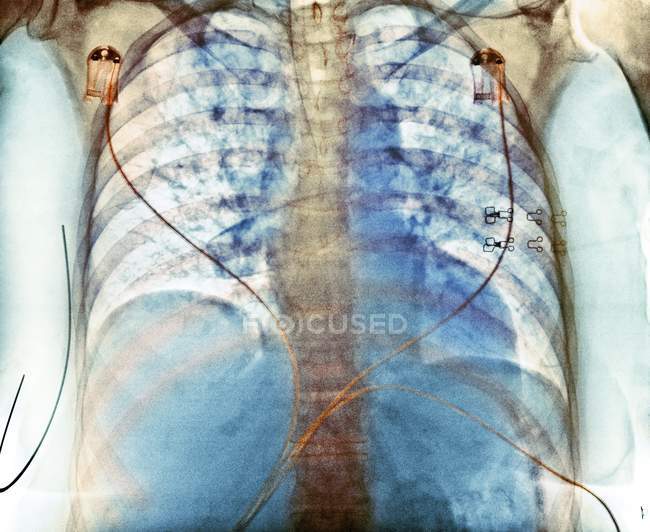 Farbiges Röntgenbild der Brust, das die Aspiration (dunkle Bereiche) in der Lunge einer 76-jährigen Patientin mit einer ausgedehnten Hirnblutung zeigt. — Stockfoto