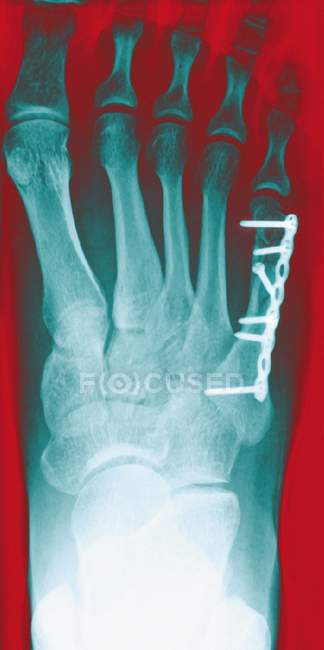 Rayons X colorés du pied droit, montrant une plaque métallique et des vis (blanches) dans l'os du pied sous le petit orteil (en haut à droite)
). — Photo de stock