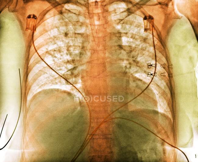 Цветной рентген грудной клетки показывает аспирацию (темные области) в легких 76-летней пациентки с обширным кровоизлиянием в мозг . — стоковое фото
