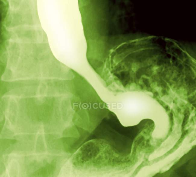 Farbiges frontales Röntgenbild einer gesunden Speiseröhre (oben links) und des Magens (unten rechts), das durch aufgenommene Bariummehl hervorgehoben wurde. — Stockfoto