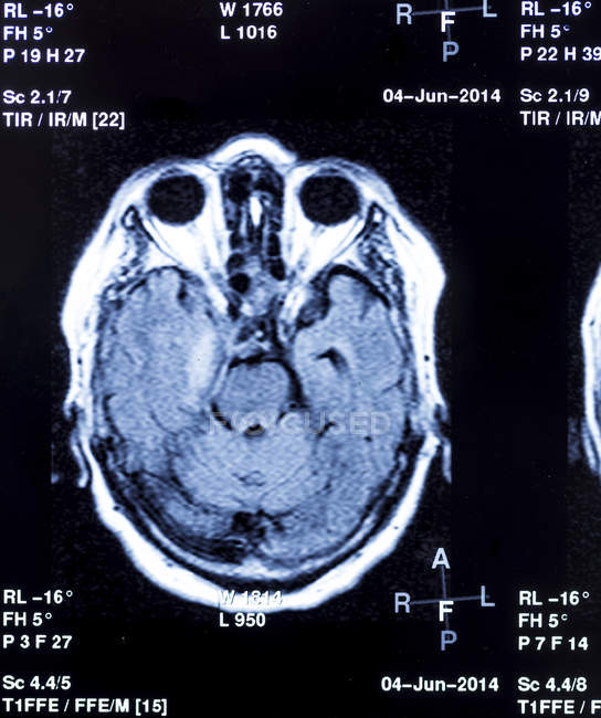 Escaneo Mri (resonancia magnética) de la cabeza humana
. - foto de stock