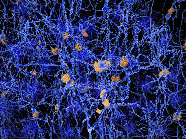 Plaques amyloïdes parmi les neurones — Photo de stock
