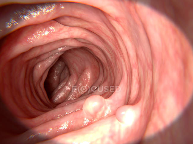 Small polyps in the intestine — Stock Photo