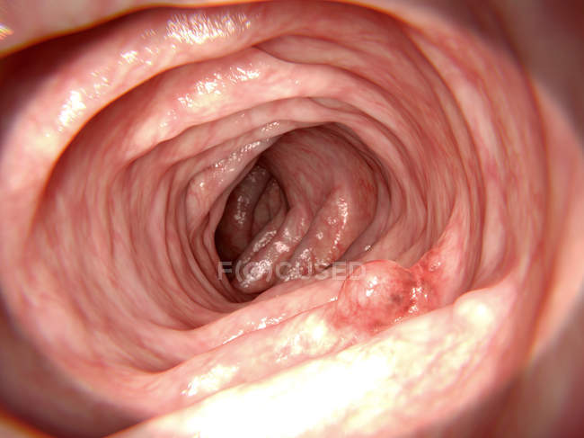 Polype adénomateux dans l'intestin — Photo de stock